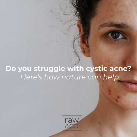 Healing Cystic Acne the Natural Way.